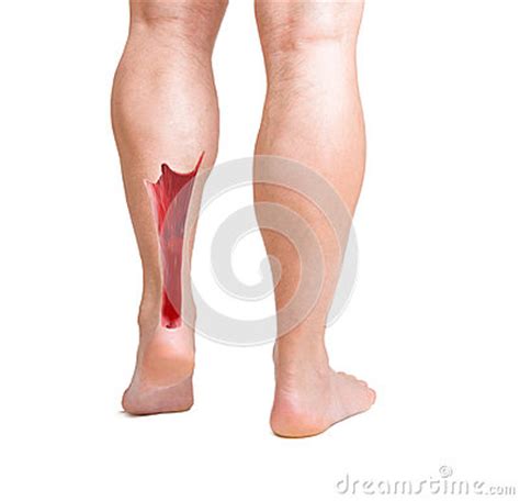 This tendon can be injured by inappropriate use from running, jumping, and climbing. Achilles Tendon With Lower Leg Muscles Stock Image - Image: 35606611