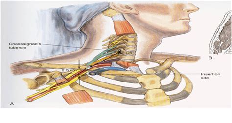 Regional Anesthesia Manual—upper Extremity Blocks Dentistry And Medicine