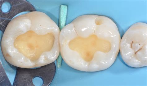Re Establishing A Stable Occlusion In A Tipped Second Molar