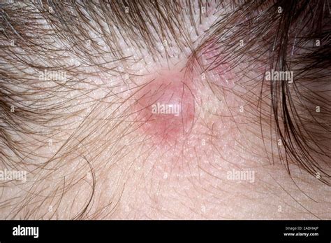 Infected Sebaceous Cyst On The Back Of A 42 Year Old Womans Neck The