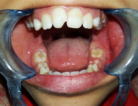 Intra Oral Swelling And Expansion Of The Involved Tissue With Fair Oral