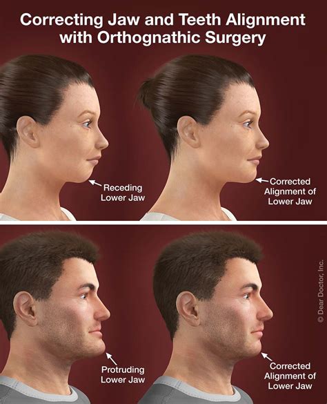How Long Does Jaw Wiring Surgery Take