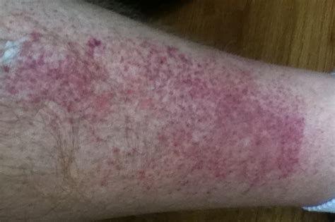 Rashes In Legs Pictures Photos