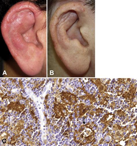 Cutaneous Rosai Dorfman Disease Of The Right Ear Responsive To