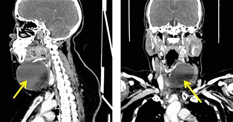 Thyroglossal Duct Cyst Radiology Cases