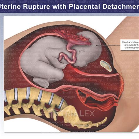 Uterine Rupture With Placental Detachment Trial Exhibits Inc