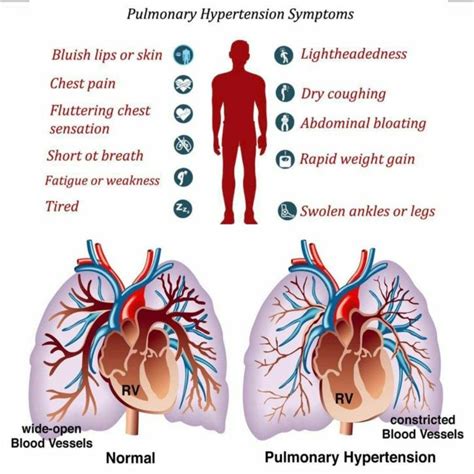 What Is Pulmonary Hypertension Disease