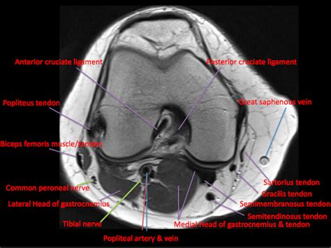 T2w axial fat sat 1. Knee Muscle Anatomy Mri : Atlas Of Knee Mri Anatomy W ...