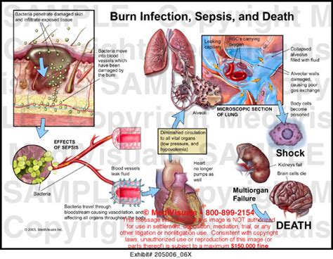 Burn Infection Sepsis And Death Medical Illustration Medivisuals