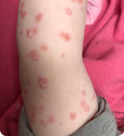 New Onset Full Body Rash Following Sore Throat In A Child Aafp