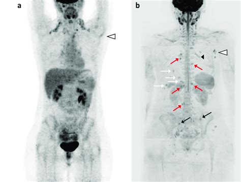 Nodal Recurrence Or Progression To Metastatic Disease 36 Years Old