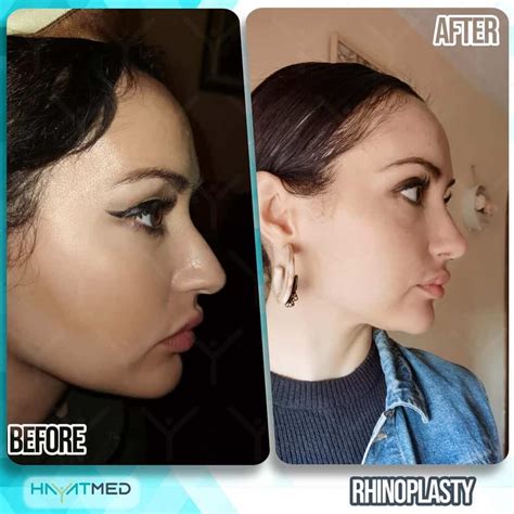 Best Nose Job Turkey 2023 Price Reviews Before And After