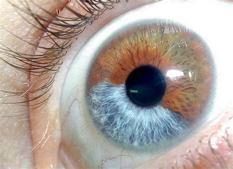 Heterochromia Also Known As A Heterochromia Iridis Or Heterochromia Iridum Is Not Necessarily