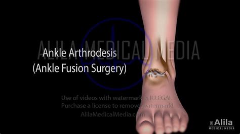 Alila Medical Media Ankle Fusion Surgery Video Medical Animation