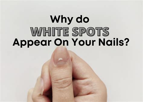 Causes Of White Spots On Nails