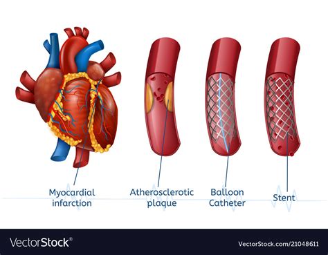 Myocardial Infarction 3d Realistic Stent In Heart Vector Image