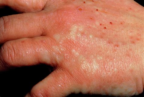 Pompholyx Eczema Of Hands With Urticaria Photograph By Dr Hc