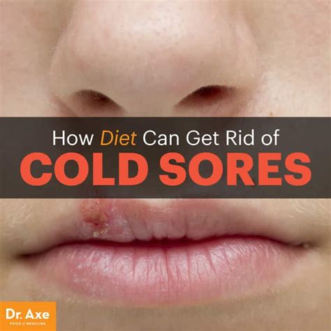 When one pops up on your lip or mouth, you probably immediately think: How to Get Rid of Cold Sores Naturally - Dr. Axe