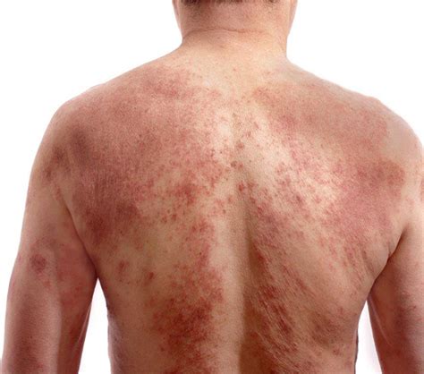 Top Urticaria Idiop Tica Cr Nica Imagenes Destinomexico Mx