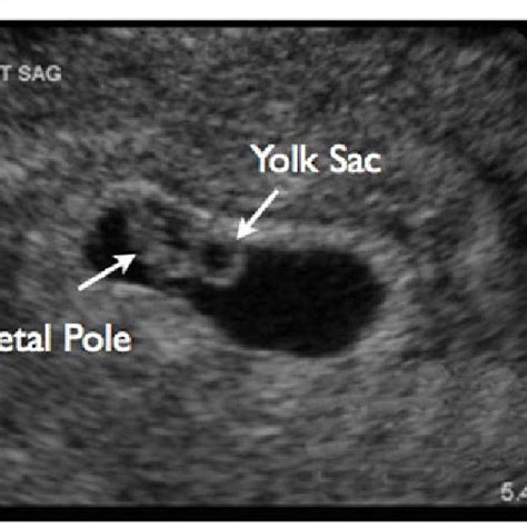 How Accurate Is Gestational Age Ultrasound