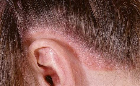 What Does Scalp Psoriasis Look Like