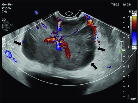 Transverse Image Of The Prostate Gland With Endorectal Ultrasound Probe