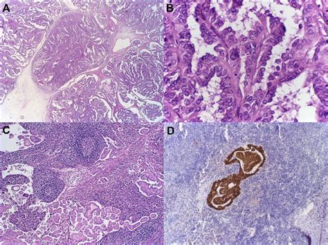 Histopathology Of Papillary Mesothelioma With Nodal Metastasis A