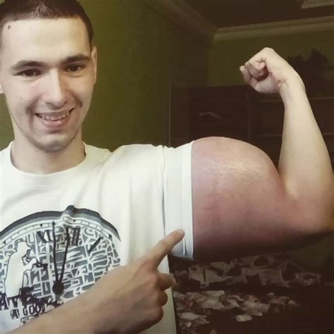 Popeye Bodybuilder Who Injects Oil Into Biceps Says He Has Biggest