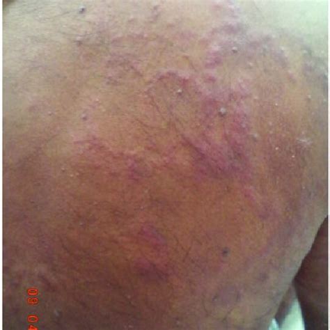 Clinical Picture Showing Multiple Annular Plaques With Erythematous