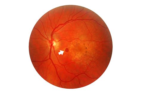 Dry Age Related Macular Degeneration Chicago Il Amd Causes Symptoms