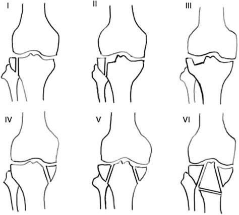 Severe Tibial Plateau Fractures Schatzker Vvi Open Reduction And