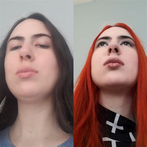 Before And After Kybella Injections Because A Bimbo Should Look