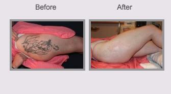 Laser Tattoo Removal Parsippany Troy Hills Weinstein Plastic Surgery