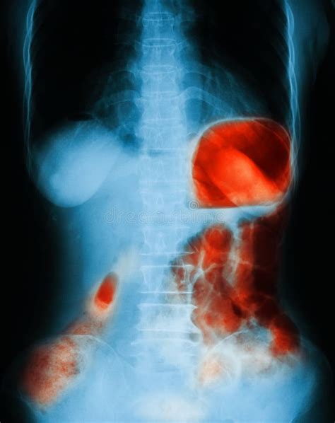 X Ray Image Of Plain Abdomen Upright Stock Photo Image Of Anatomy