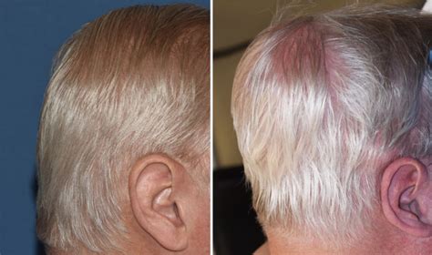 Flat Back Of The Head Custom Skull Implant Result Side View Dr Barry