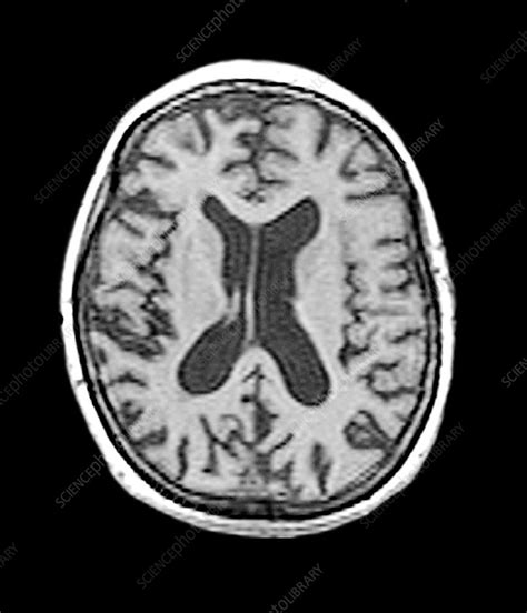 Alzheimers Disease Mri Stock Image M1080482 Science Photo Library