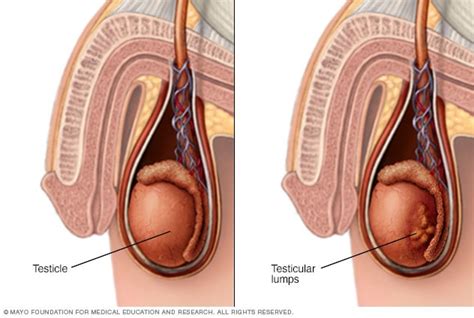 Signs You May Have Testicular Cancer Cancerwalls