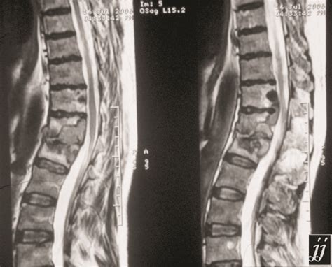 Radioogle Spine Vertebral Body Compression Fracture Mri