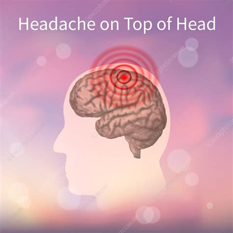 Headache On Top Of The Head Illustration Stock Image F0250123 Science Photo Library