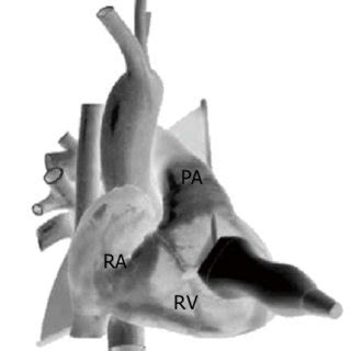 Parasternal Right Ventricular Inflow Outflow View Anterior Projection