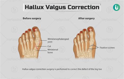 Hallux Valgus Correction Procedure Purpose Results Cost Price