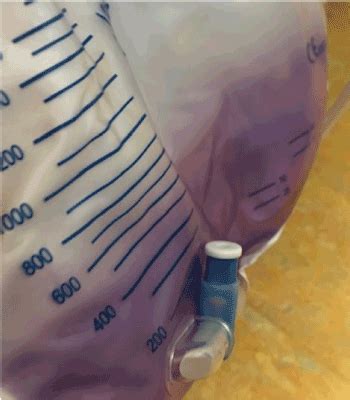 This investigation reports the case of a 58 years woman was previously diagnosed with ckd resulting from diabetic nephropathy. The purple urine bag syndrome