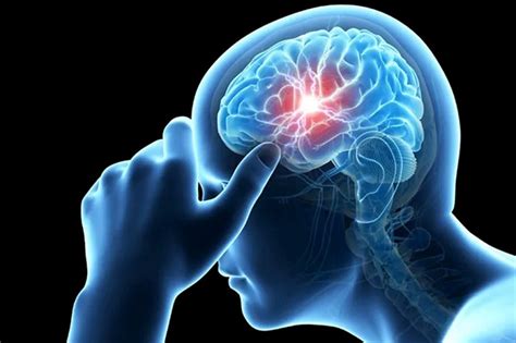 What Is Right Migraine Causes And Symptoms