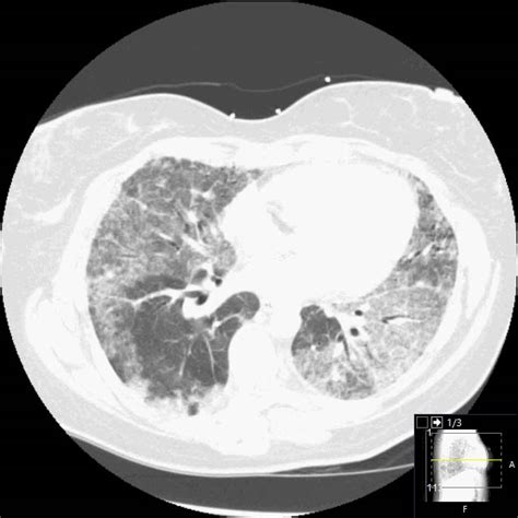 Invasive Mucinous Adenocarcinoma Of The Lung Mimicking Pneumonia