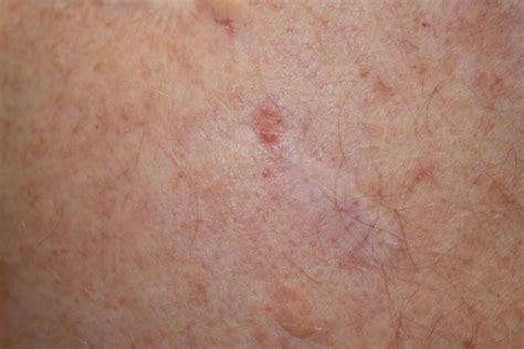 Basal Cell Carcinoma A Review Clinical Advisor