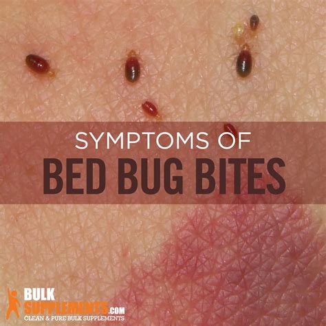 Bed Bug Bites Characteristics Causes And Treatment