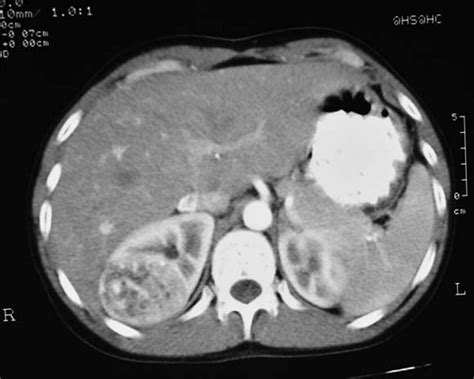 Angiomyolipoma Ultrasound