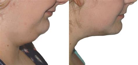 Get Rid Of Double Chin Permanently No Surgery Required