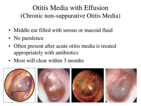 Otitis Media Symptoms And Causes Of Middle Ear Infect