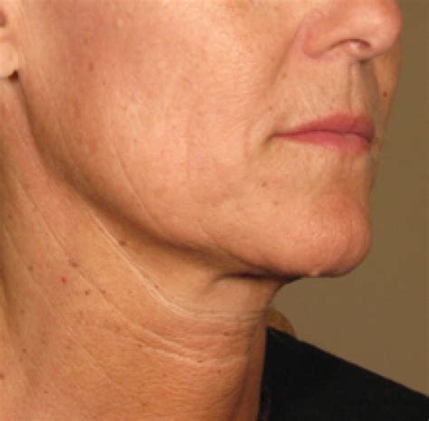 Under Chin Results Lowell Medical